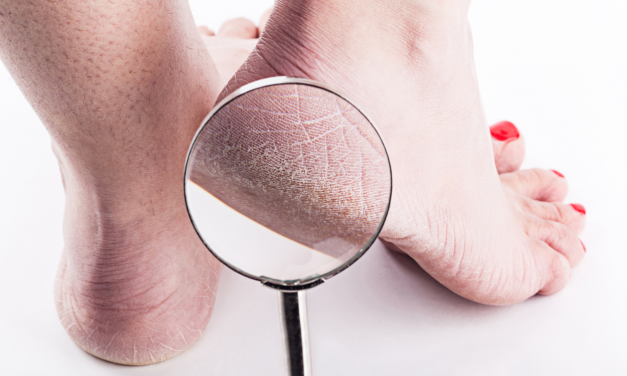 Wat kan je doen tegen ruwe huid en kloven op je voeten?