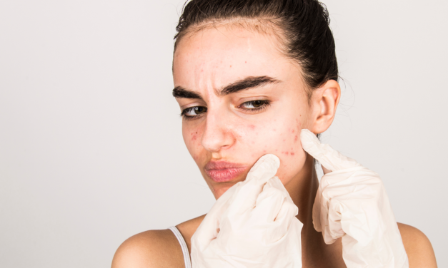 Wat kan je doen aan acné?